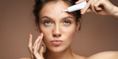 Фаговий препарат проти акне готується до II фази випробувань