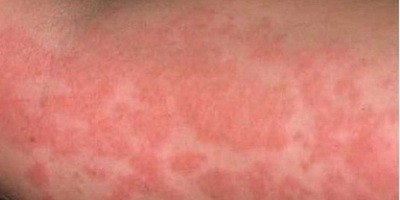 Бактеріофаги як протиалергічні засоби