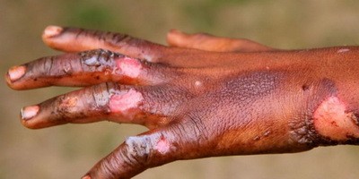 Сучасні можливості терапії та профілактики мікробної інфекції в практиці комбустіолога