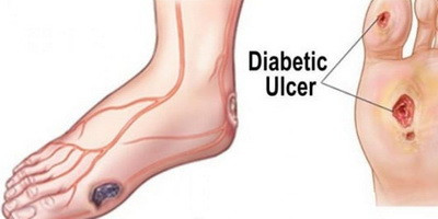 Фаговий коктейль проти мультирезистентного стафілокока при діабетичній стопі