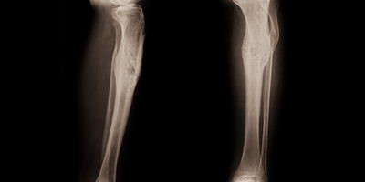 Клінічний випадок: фаготерапія хронічного остеомієліту