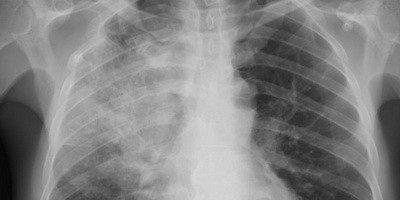 Фаготерапія інфекції, викликаної Klebsiella pneumoniae