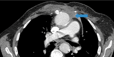 News Бактеріофаги використовуються для лікування інфекції судинного трансплантата